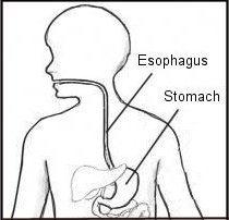 Infant Regurgitation InfantRegurgitation